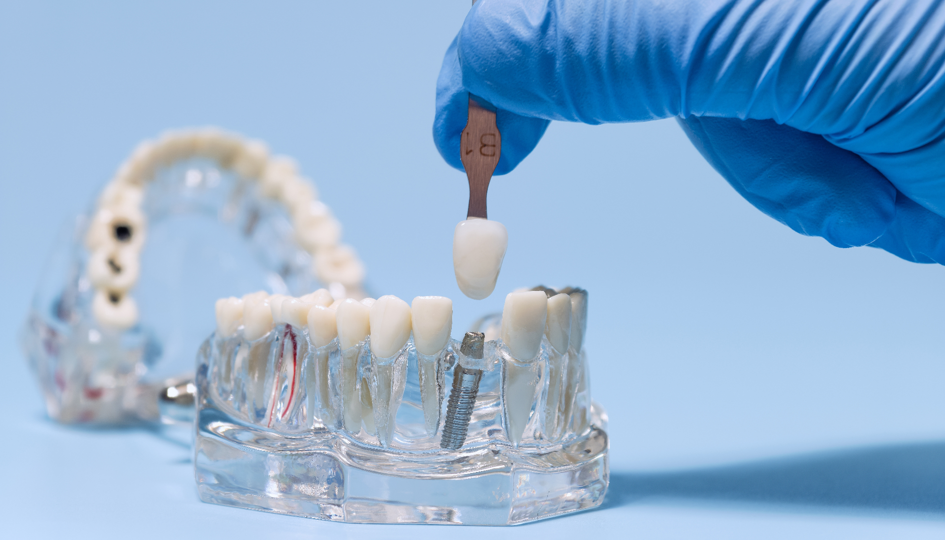 Implante unitario o puente dental: cuál conviene cuando falta una sola pieza